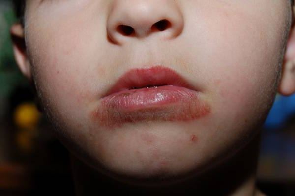 Bėrimas prie vaiko burnos: kokios ligos sukelia tai?