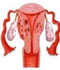 Adenomyozė ir endometriozė - koks skirtumas? Koks skirtumas tarp endometriozės ir adenomyozės?