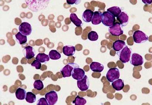 Kas yra leukemija? 